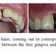Image for article titled This Woman’s Mouth Keeps Growing Hairs